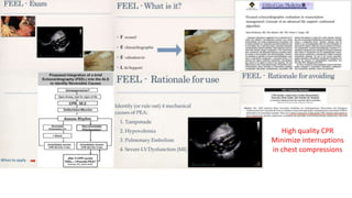 High quality CPR
Minimize interruptions
in chest compressions
 
