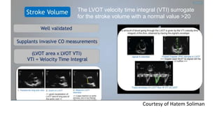 Courtesy of Hatem Soliman
The LVOT velocity time integral (VTI) surrogate
for the stroke volume with a normal value >20
 