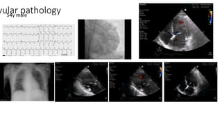vular pathology54y male
 