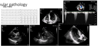 vular pathology58y male
 