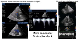 78y male, important blood loss after abdominal surgery 78y male, echo before surgery
Mixed component
Obstructive shock
 