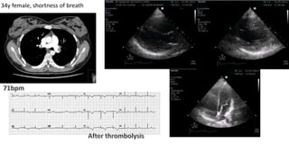 34y female, shortness of breath
 