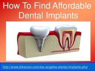 How To Find Affordable 
Dental Implants 
http://www.drkezian.com/los-angeles-dental-implants.php 
 
