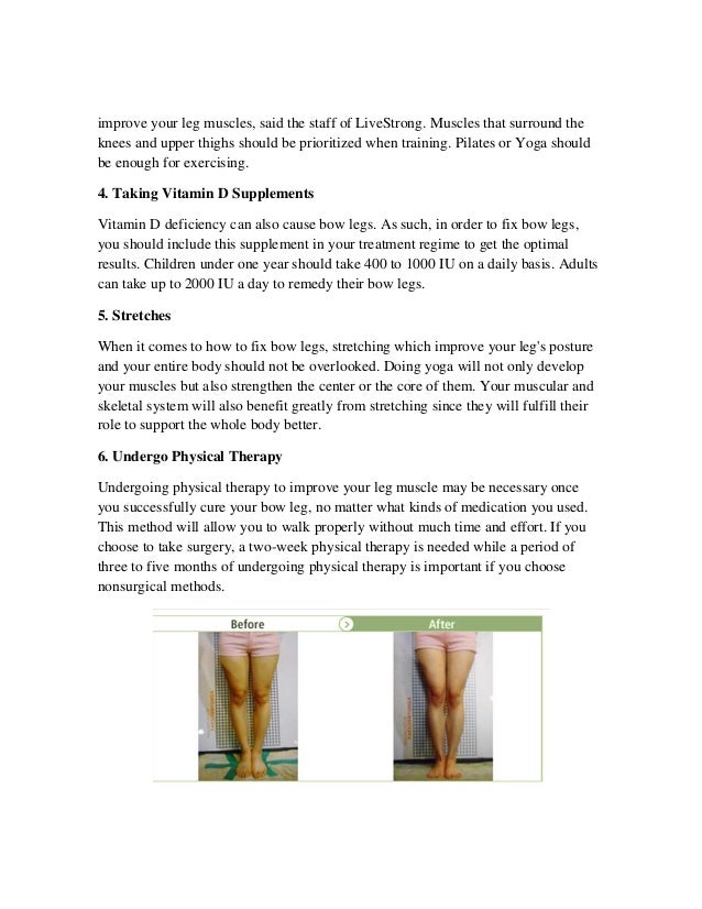 Learn How To Fix Bow Legs With Some Simple And Practical Tips