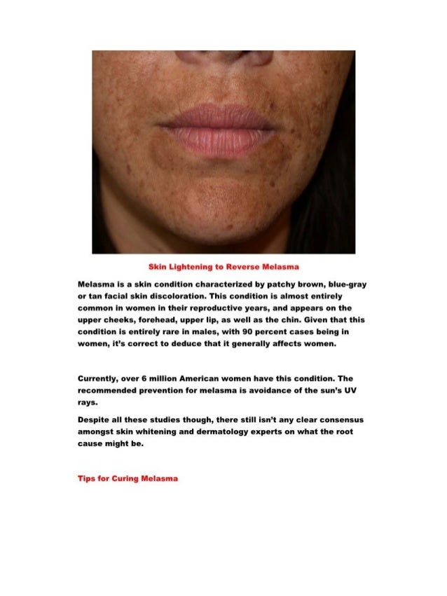bleaching cream for age spots