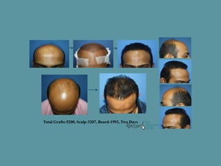 Result after 10 months of hair transplant
5020 grafts in two days = 3015 from scalp + 2005 from beard
 