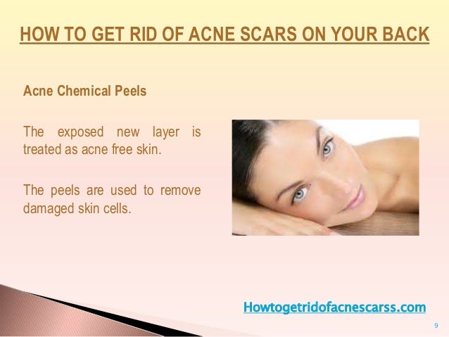 Best 25+ Back acne remedies ideas on Pinterest - Head and ...