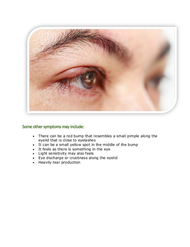 How to get rid of a stye