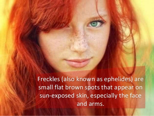 freckles ephelides freckle appear