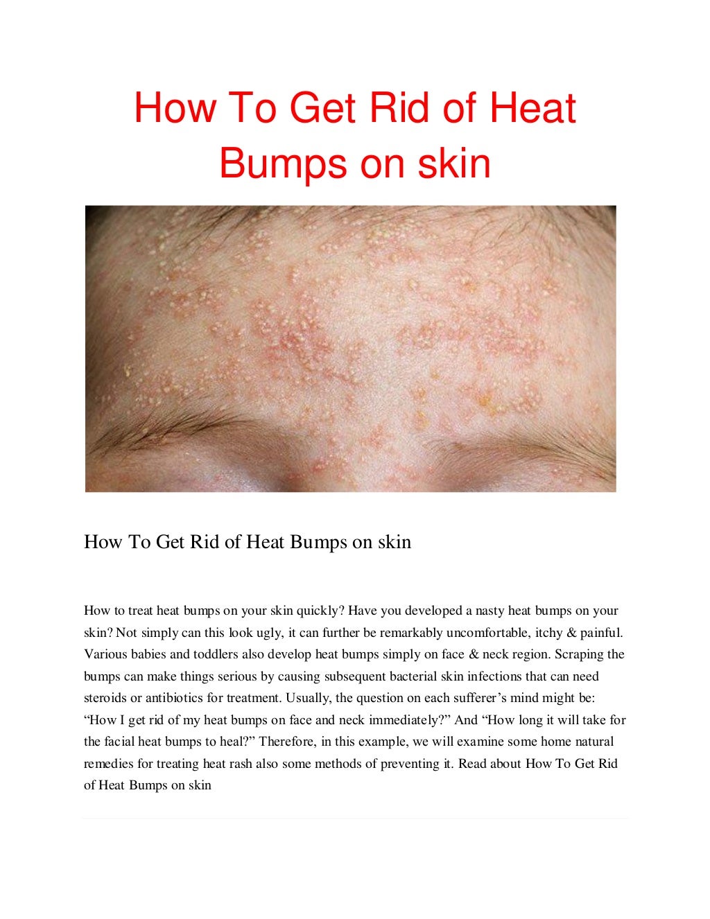 How to get rid of heat bumps on skinpdf2