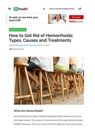 What Are Hemorrhoids?
Hemorrhoids are clumps of dilated (enlarged) blood vessels in the anus
and lower rectum. The rectum is the last area of the large intestine before
it exits to the anus. The anus is the end of the digestive tract where feces
Diseases & Conditions
How to Get Rid of Hemorrhoids:
Types, Causes and Treatments
Reviewed By Charles Patrick Davis, MD, PhD on 1/11/2019
Privacy & Trust Info

Or pick up now from your
local CVS®
Get started
1/ 28
How to Get Rid of Hemorrhoid…
 OnHealth 
 