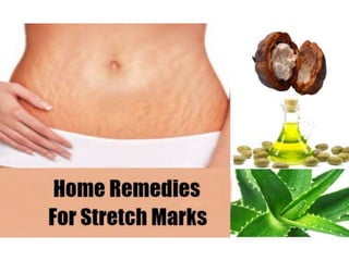 How to Get Rid of Stretch Marks - Option Home Remedies