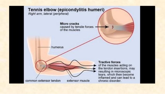 How To Get Rid Of Tendonitis In The Elbow How To Get Rid Of Tendonitis In The Elbow