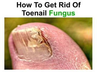 How To Get Rid Of Toenail  Fungus 
