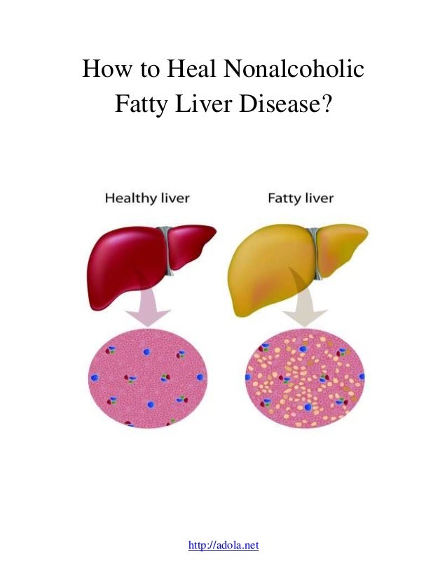 how to to heel how to heal nonalcoholic fatty liver disease how to to heel how to heal nonalcoholic fatty liver disease