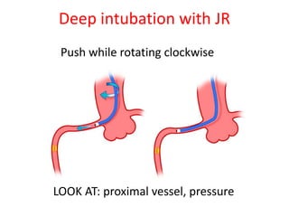 Deep intubation with JR
Push while rotating clockwise
LOOK AT: proximal vessel, pressure
