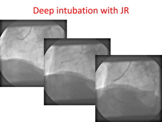 Deep intubation with JR