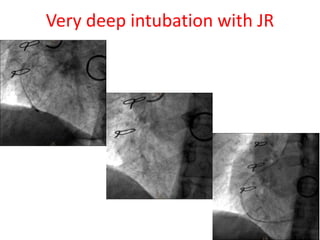 Very deep intubation with JR