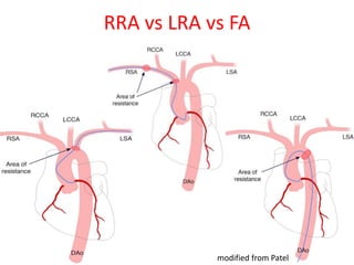 RRA vs LRA vs FA
modified from Patel