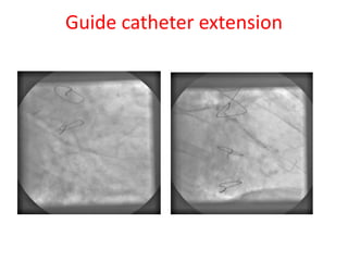 Guide catheter extension