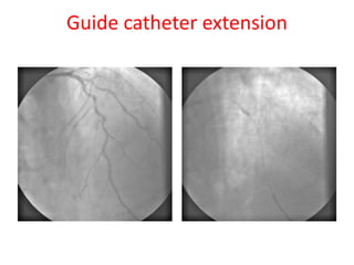 Guide catheter extension