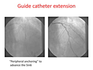 Guide catheter extension
“Peripheral anchoring” to
advance the 5in6