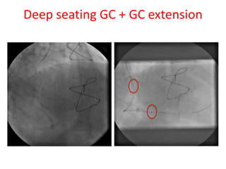 Deep seating GC + GC extension