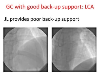 GC with good back-up support: LCA
JL provides poor back-up support