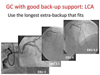 GC with good back-up support: LCA
Use the longest extra-backup that fits
EBU 3
EBU 3.5
EBU 4
EBU 4.5