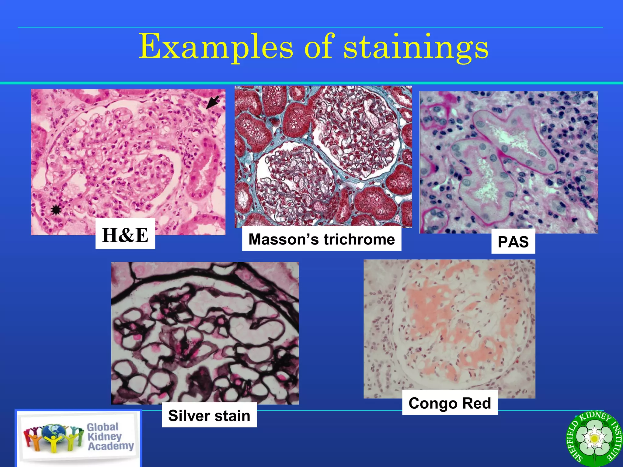 How to Interpret a Kidney Biopsy | PPT