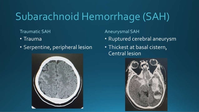Subarachnoid Hemorrhage (SAH)
 