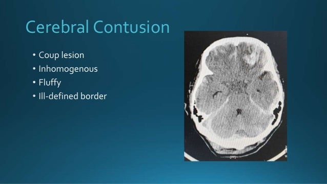 Cerebral Contusion
 