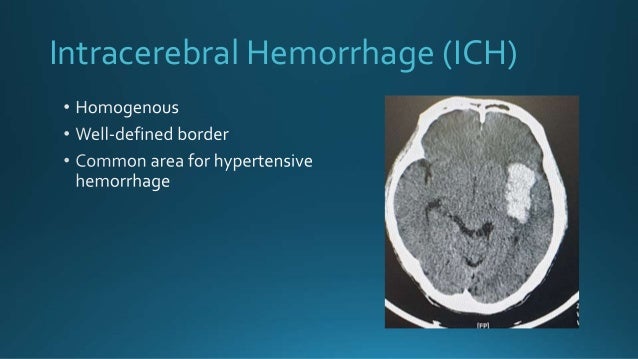 Intracerebral Hemorrhage (ICH)
 