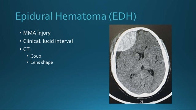Epidural Hematoma (EDH)
 