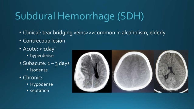 Subdural Hemorrhage (SDH)
 