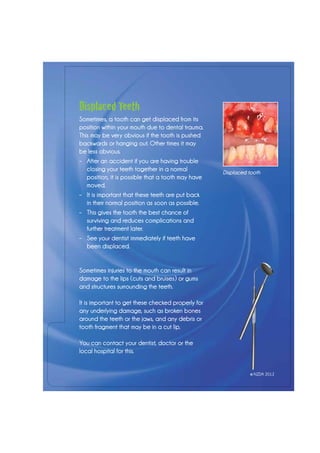 Displaced Teeth
Sometimes, a tooth can get displaced from its
position within your mouth due to dental trauma.
This may be very obvious if the tooth is pushed
backwards or hanging out. Other times it may
be less obvious.
–	 After an accident if you are having trouble
closing your teeth together in a normal
position, it is possible that a tooth may have
moved.
–	 It is important that these teeth are put back
in their normal position as soon as possible.
–	 This gives the tooth the best chance of
surviving and reduces complications and
further treatment later.
–	 See your dentist immediately if teeth have
been displaced.
Sometimes injuries to the mouth can result in
damage to the lips (cuts and bruises) or gums
and structures surrounding the teeth.
It is important to get these checked properly for
any underlying damage, such as broken bones
around the teeth or the jaws, and any debris or
tooth fragment that may be in a cut lip.
You can contact your dentist, doctor or the
local hospital for this.
Displaced tooth
© NZDA 2012
 