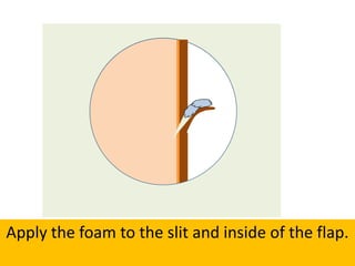 Apply the foam to the slit and inside of the flap.
 