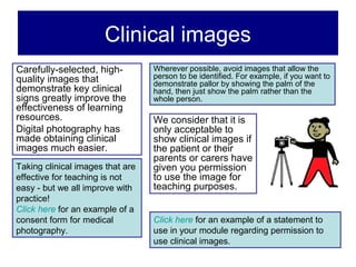 Clinical images
Carefully-selected, high-         Wherever possible, avoid images that allow the
quality images that               person to be identified. For example, if you want to
                                  demonstrate pallor by showing the palm of the
demonstrate key clinical          hand, then just show the palm rather than the
signs greatly improve the         whole person.
effectiveness of learning
resources.                        We consider that it is
Digital photography has           only acceptable to
made obtaining clinical           show clinical images if
images much easier.               the patient or their
                                  parents or carers have
Taking clinical images that are   given you permission
effective for teaching is not     to use the image for
easy - but we all improve with    teaching purposes.
practice!
Click here for an example of a
consent form for medical          Click here for an example of a statement to
photography.                      use in your module regarding permission to
                                  use clinical images.
 