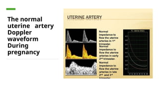 HOW TO PERFORM AND INTERPRET UTERINE ARTERY DOPPLER copy.pptx