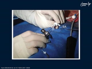 Heart 2009;95:85–92. doi:10.1136/hrt.2007.135939
 