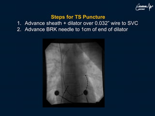 Steps for TS Puncture
1. Advance sheath + dilator over 0.032” wire to SVC
2. Advance BRK needle to 1cm of end of dilator
 