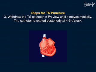 Steps for TS Puncture
3. Withdraw the TS catheter in PA view until it moves medially.
The catheter is rotated posteriorly at 4-6 o’clock.
 
