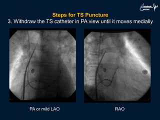 Steps for TS Puncture
3. Withdraw the TS catheter in PA view until it moves medially
PA or mild LAO RAO
 
