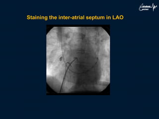 Staining the inter-atrial septum in LAO
 