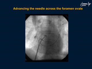 Advancing the needle across the foramen ovale
 