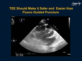 TEE Should Make it Safer and Easier than
Fluoro Guided Puncture
 