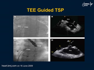 TEE Guided TSP
heart.bmj.com on 16 June 2009
 