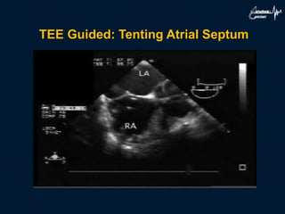 TEE Guided: Tenting Atrial Septum
 