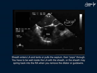 Sheath enters LA and tents or pulls the septum, then “pops” through.
You have to be well inside the LA with the sheath, or the sheath may
spring back into the RA when you remove the dilator or guidewire.
 