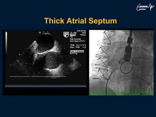 Thick Atrial Septum
 